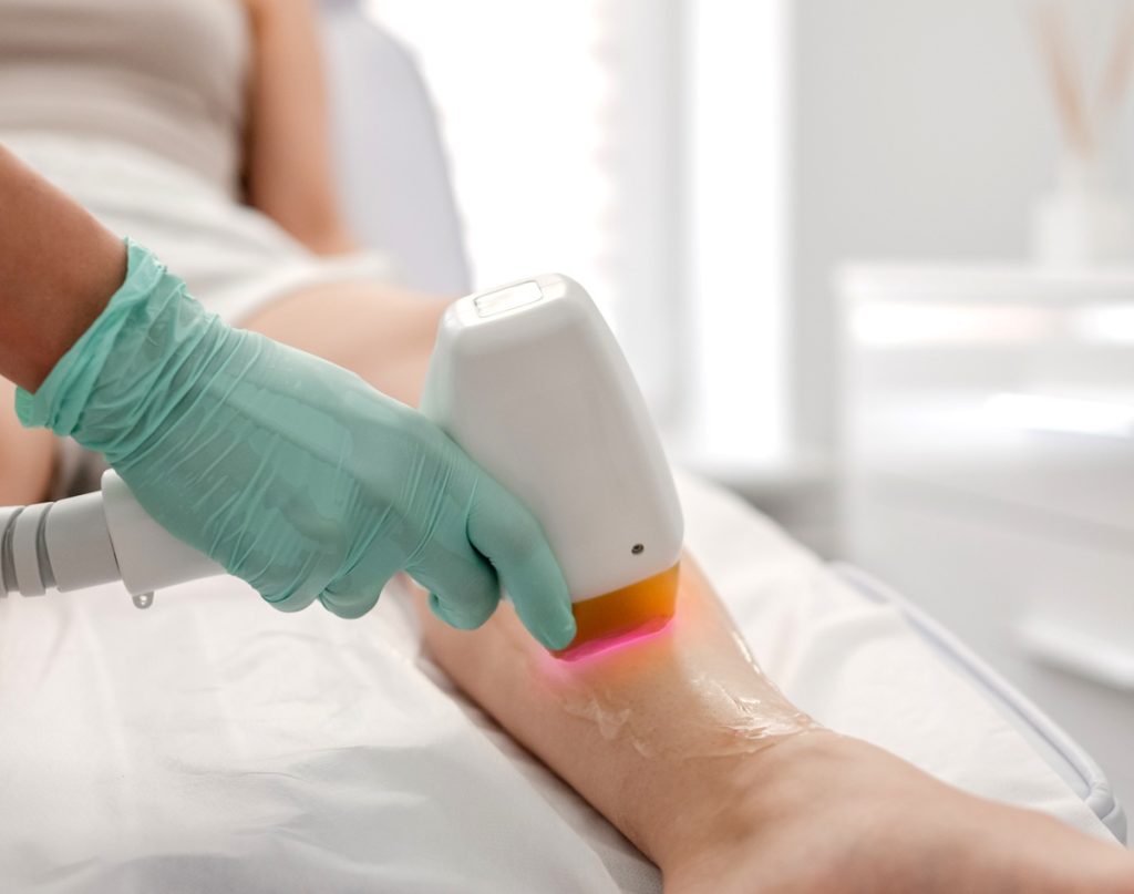 depilacion laser marbella